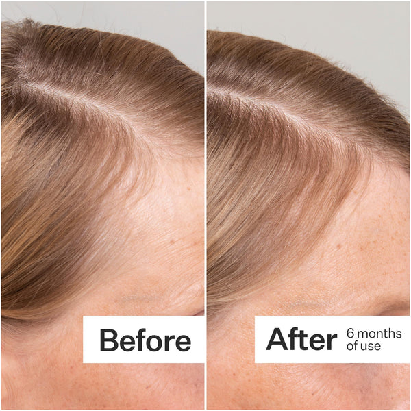 Before/After of hair growth when using Act+Acre Stem Cell Serum