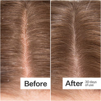 A side-by-side before-and-after comparison of a person's hair part, showing dandruff and scalp flakes in the 'Before' panel and clearer, smoother hair in the 'After' panel, with text reading 'After 30 days of use'.