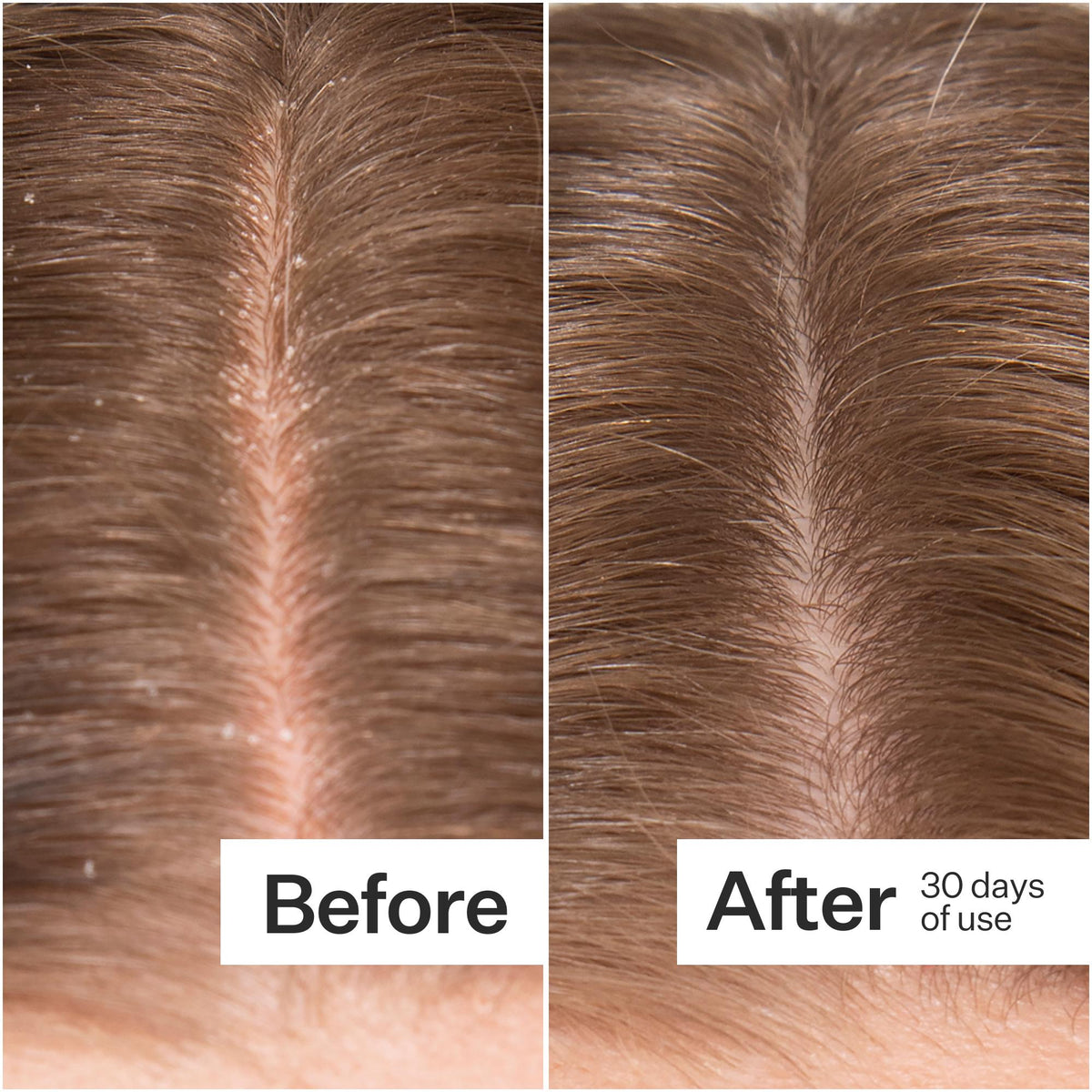 A side-by-side before-and-after comparison of a person's hair part, showing dandruff and scalp flakes in the 'Before' panel and clearer, smoother hair in the 'After' panel, with text reading 'After 30 days of use'.