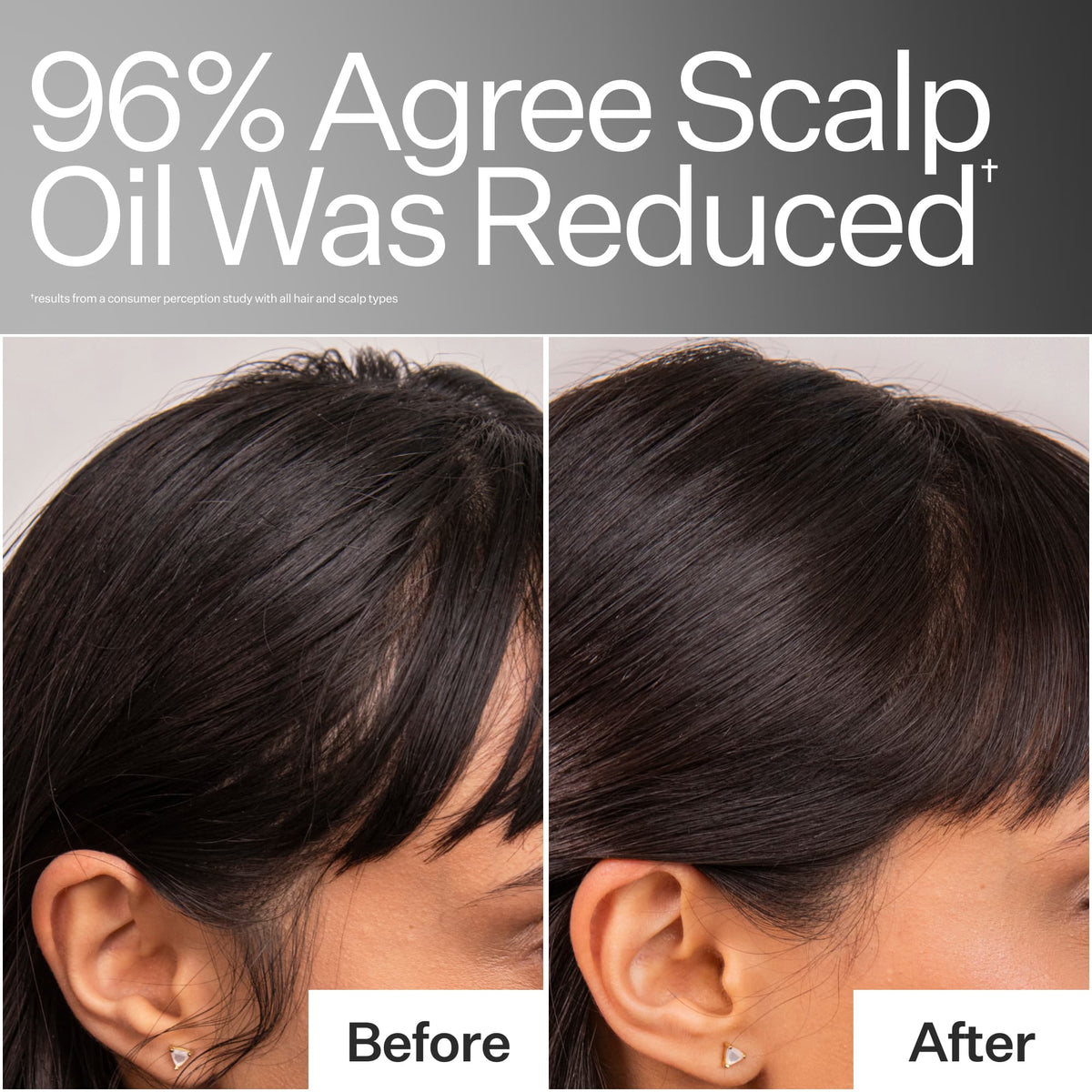 Before / After when using Act+Acre 4% Niacinamide Oily Scalp Serum