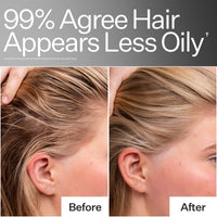 Before/After when using Act+Acre 4% Niacinamide Oily Scalp Serum