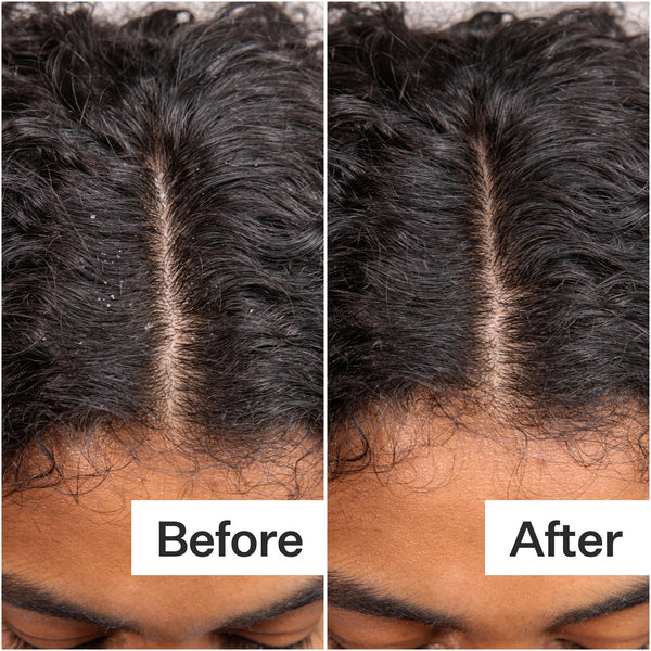 Before/After of scalp when using Act+Acre Daily Hydro™ Scalp Serum