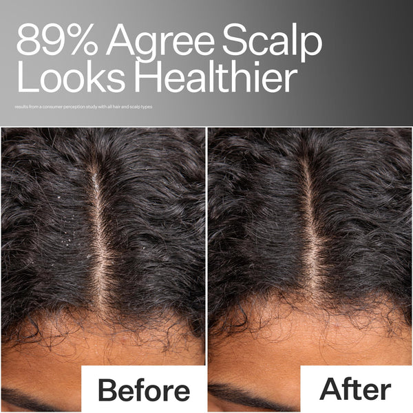 Before/After of improved scalp health Act+Acre Scalp Relief System