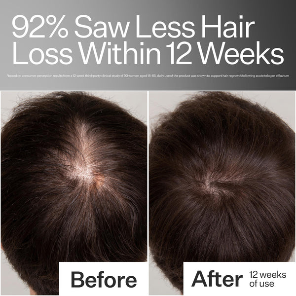 Before/After of decreased hair loss when using  Act+Acre Stem Cell Scalp Serum 